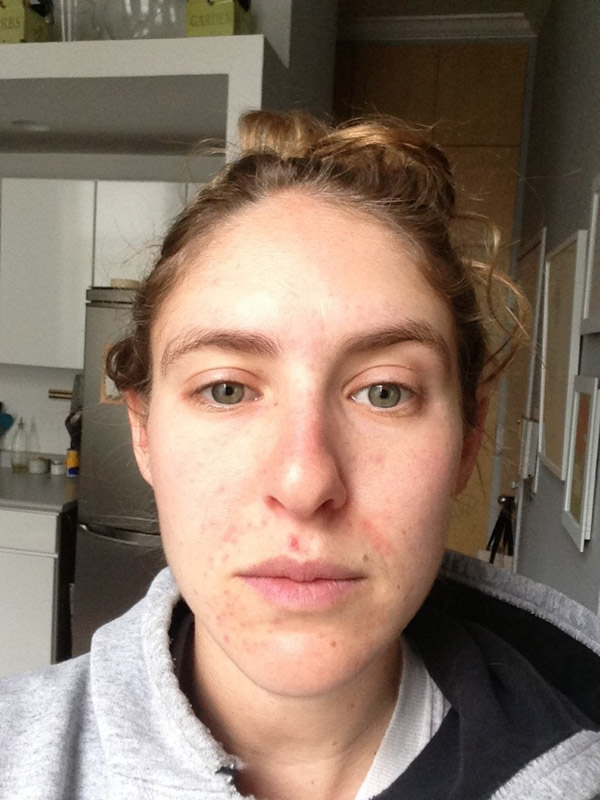 perioral dermatitis healing stages - picture of the author before treatment